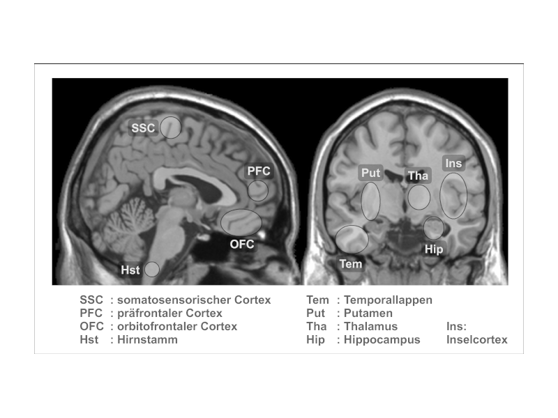 Zwei Hirnschnitte mit markierten Regionen